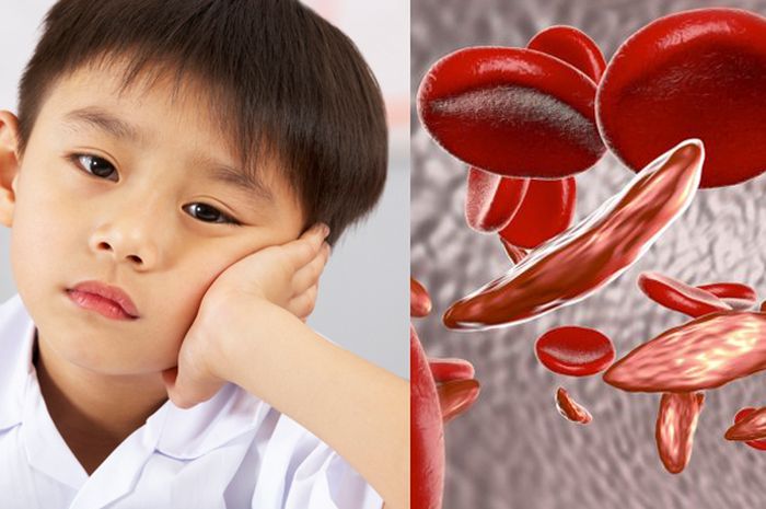 Mengenal Penyakit Sel Sabit, Penyakit Langka yang Susah Disembuhkan ...